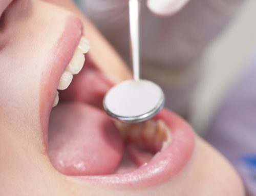 Étude: L’huile de noix de coco arrête les caries dentaires et le Candida Albicans en bloquant la bactérie Streptococcus Mutans